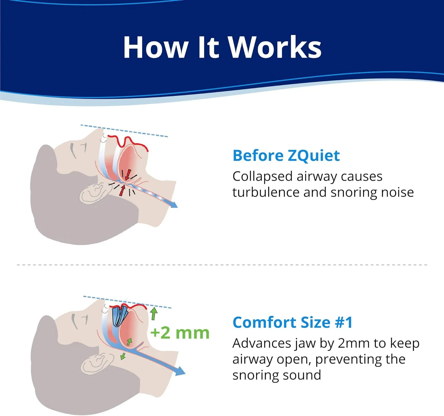 Anti-Snoring Mouthpiece, Comfort Size #1, Single Refill, Blue, BPA-Free, Medical-Grade Material
